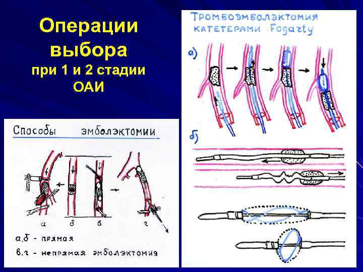 Операции выбора при 1 и 2 стадии ОАИ 