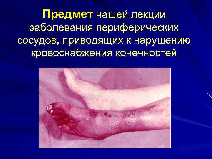 Предмет нашей лекции заболевания периферических сосудов, приводящих к нарушению кровоснабжения конечностей 
