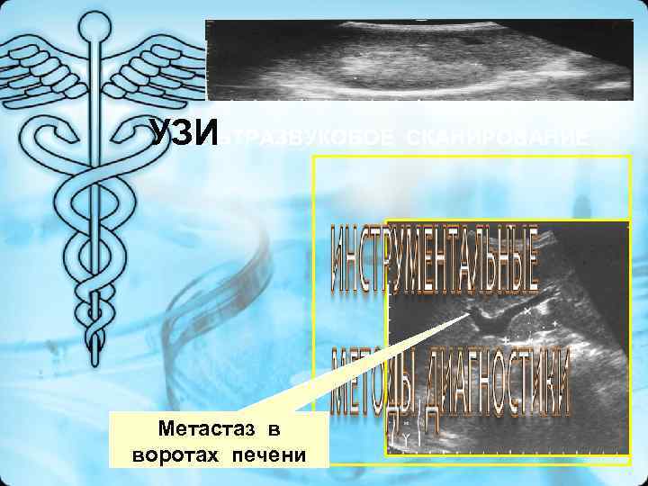 УЗИ УЛЬТРАЗВУКОВОЕ СКАНИРОВАНИЕ Метастаз в воротах печени УЗИ УЛЬТРАЗВУКОВОЕ СКАНИРОВАНИЕ Метастаз в воротах печени
