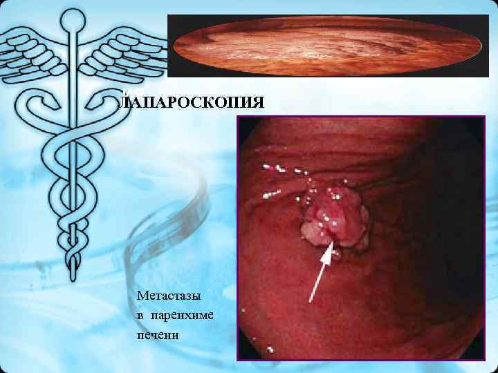 ИЯ ЛАПАРОСКОПИЯ Метастазы в паренхиме печени ИЯ ЛАПАРОСКОПИЯ Метастазы в паренхиме печени