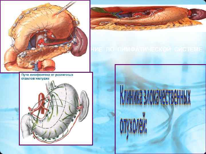 РАСПРОСТРАНЕНИЕ ПО ЛИМФАТИЧЕСКОЙ СИСТЕМЕ РАСПРОСТРАНЕНИЕ ПО ЛИМФАТИЧЕСКОЙ СИСТЕМЕ