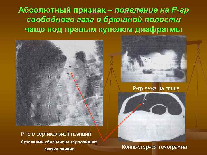 Абсолютный признак – появление на Р-гр свободного газа в брюшной полости чаще под правым