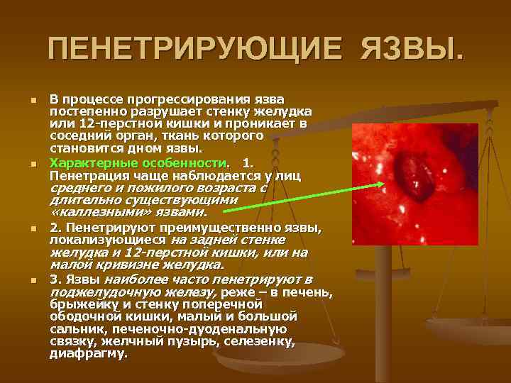   ПЕНЕТРИРУЮЩИЕ ЯЗВЫ. n  В процессе прогрессирования язва постепенно разрушает стенку желудка