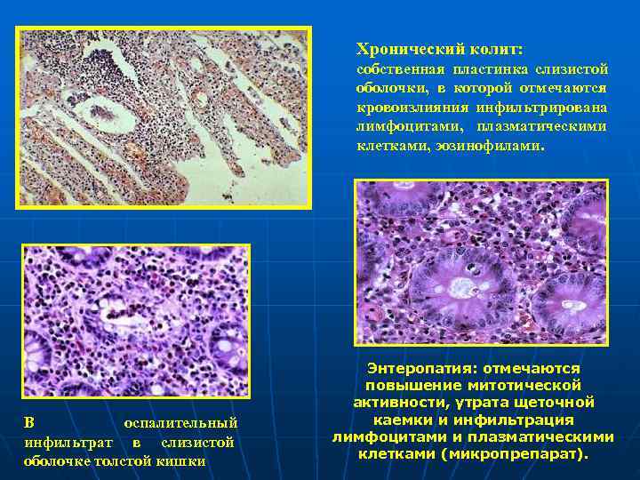       Хронический колит:      