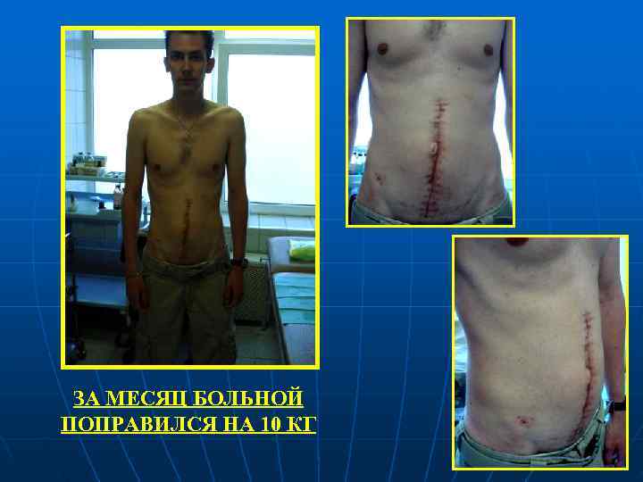  ЗА МЕСЯЦ БОЛЬНОЙ ПОПРАВИЛСЯ НА 10 КГ 