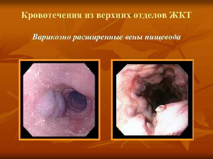 Кровотечения из верхних отделов ЖКТ Варикозно расширенные вены пищевода 