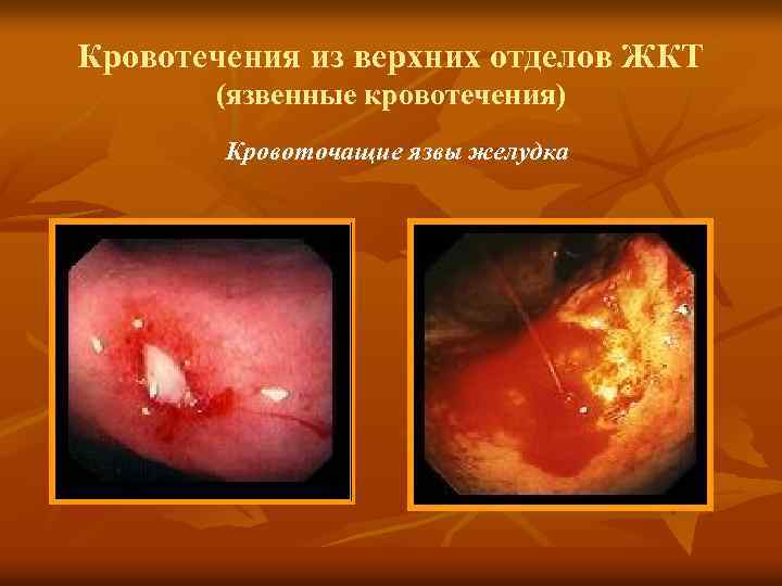 Кровотечения из верхних отделов ЖКТ (язвенные кровотечения) Кровоточащие язвы желудка 