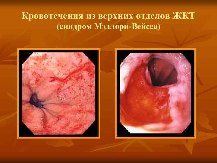 Кровотечения из верхних отделов ЖКТ (синдром Мэллори-Вейсса) 