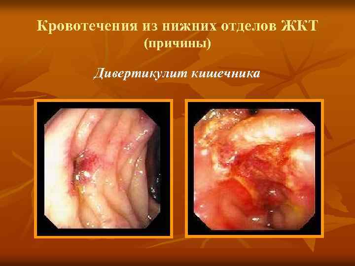 Кровотечения из нижних отделов ЖКТ (причины) Дивертикулит кишечника 