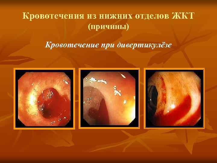 Кровотечения из нижних отделов ЖКТ (причины) Кровотечение при дивертикулёзе 