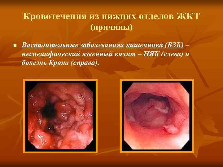 Кровотечения из нижних отделов ЖКТ (причины) n Воспалительные заболеваниях кишечника (ВЗК) – неспецифический язвенный