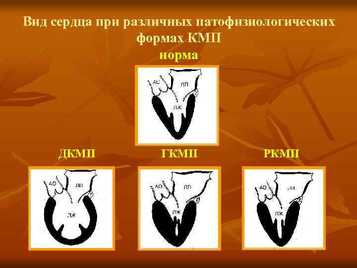 Вид сердца при различных патофизиологических формах КМП норма ДКМП ГКМП РКМП 