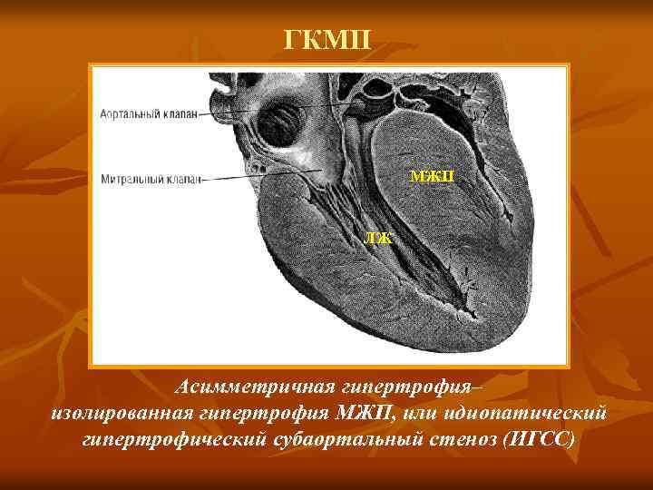 Базальная гипертрофия мжп