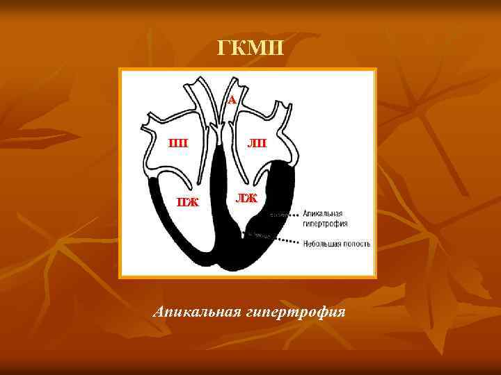 ГКМП А ПП ПЖ ЛП ЛЖ Апикальная гипертрофия 