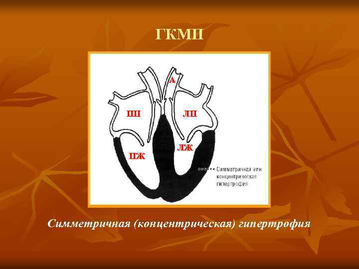 ГКМП А ПП ПЖ ЛП ЛЖ Симметричная (концентрическая) гипертрофия 
