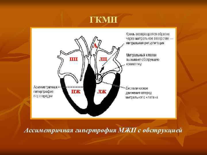 ГКМП А ПП ПЖ ЛП ЛЖ Ассиметричная гипертрофия МЖП с обструкцией 