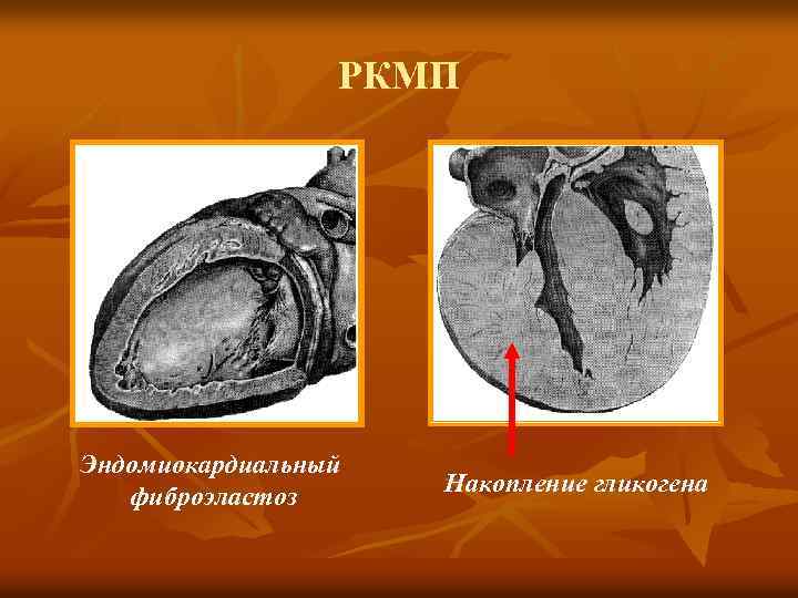РКМП Эндомиокардиальный фиброэластоз Накопление гликогена 