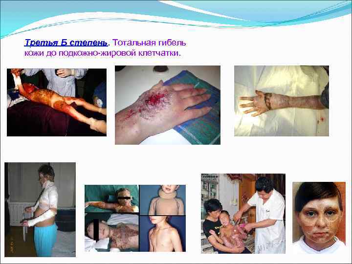 Третья Б степень. Тотальная гибель Третья Б степень кожи до подкожно-жировой клетчатки. 