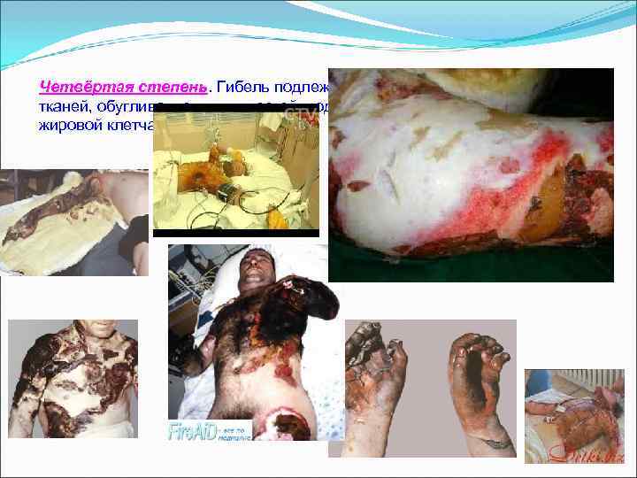 Четвёртая степень. Гибель подлежащих тканей, обугливание мышц, костей, подкожно- жировой клетчатки. 