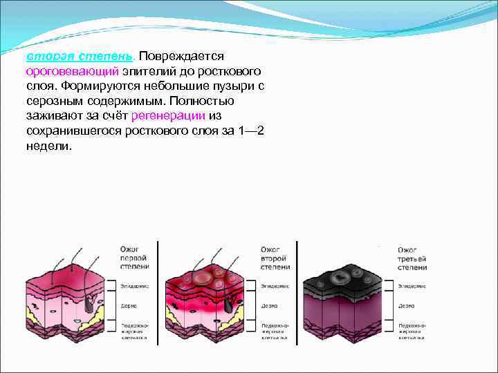 вторая степень. Повреждается вторая степень ороговевающий эпителий до росткового слоя. Формируются небольшие пузыри с