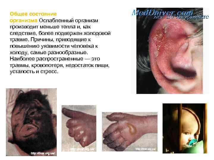 Общее состояние организма Ослабленный организм производит меньше тепла и, как следствие, более подвержен холодовой