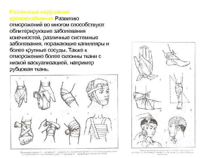 Различные нарушения кровоснабжения Развитию кровоснабжения отморожений во многом способствуют облитерируюшие заболевания конечностей, различные системные