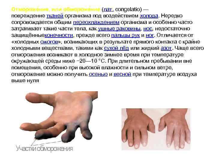 Отмороже ние, или обмороже ние (лат. congelatio) —      