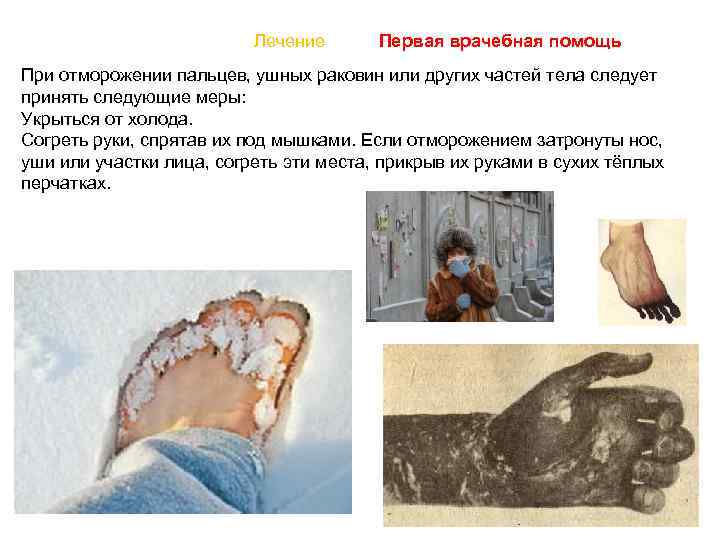     Лечение  Первая врачебная помощь При отморожении пальцев, ушных
