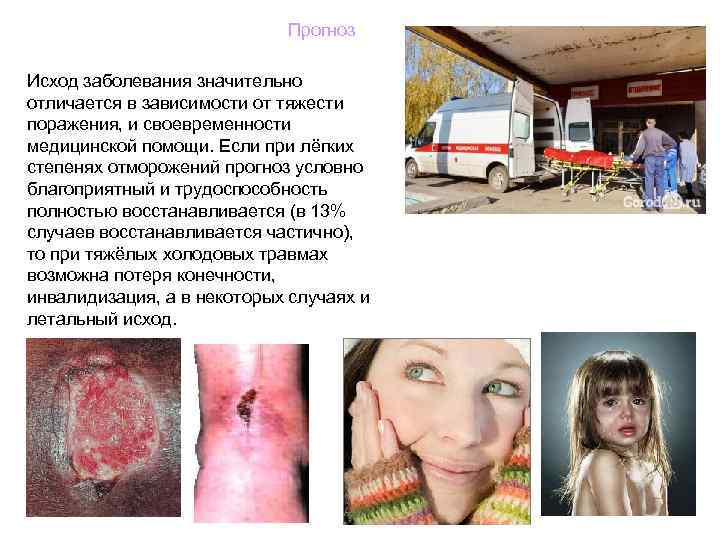      Прогноз Исход заболевания значительно отличается в зависимости от тяжести