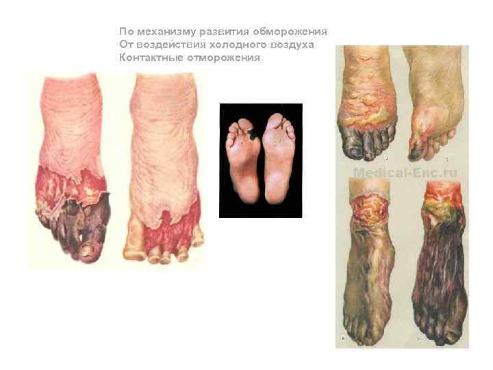 По механизму развития обморожения От воздействия холодного воздуха Контактные отморожения 