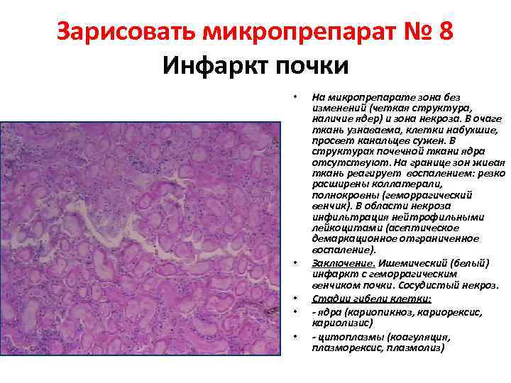Зарисовать микропрепарат № 8 Инфаркт почки • • • На микропрепарате зона без изменений