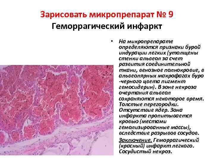 Зарисовать микропрепарат № 9 Геморрагический инфаркт • На микропрепарате определяются признаки бурой индурации легких