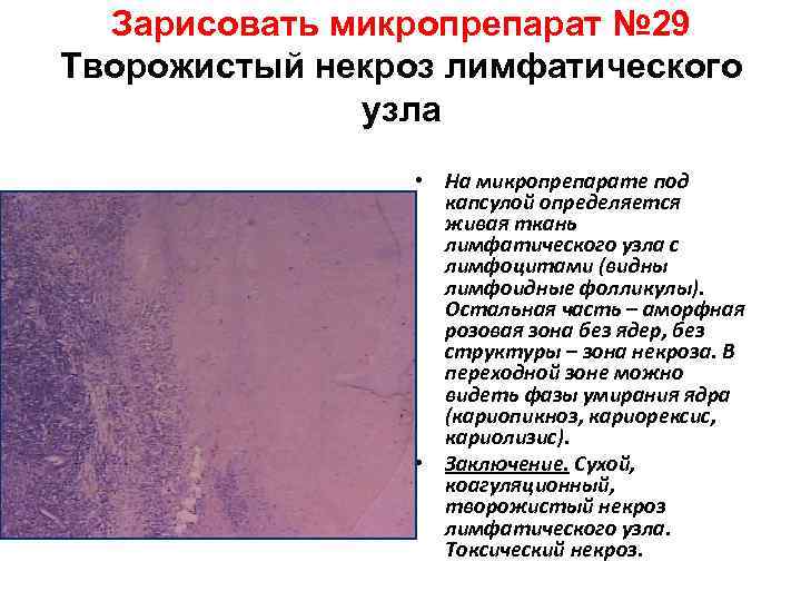 Зарисовать микропрепарат № 29 Творожистый некроз лимфатического узла • На микропрепарате под капсулой определяется