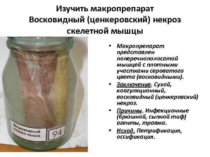 Изучить макропрепарат Восковидный (ценкеровский) некроз скелетной мышцы • Макропрепарат представлен поперечнополосатой мышцей с плотными