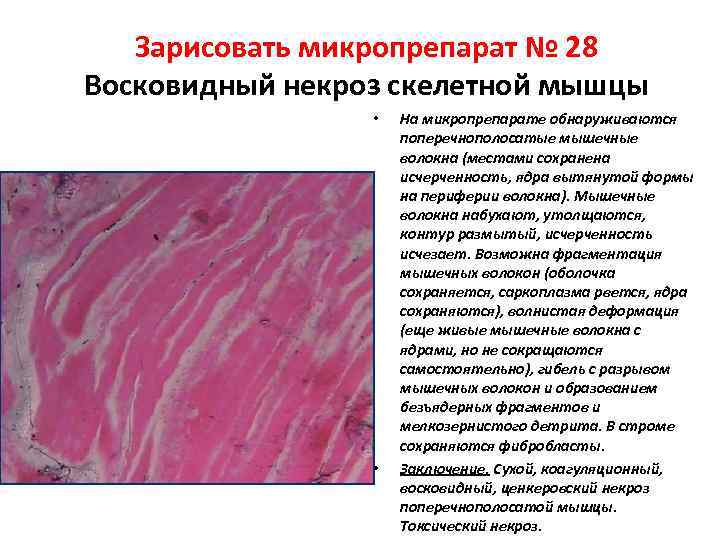 Зарисовать микропрепарат № 28 Восковидный некроз скелетной мышцы • • На микропрепарате обнаруживаются поперечнополосатые