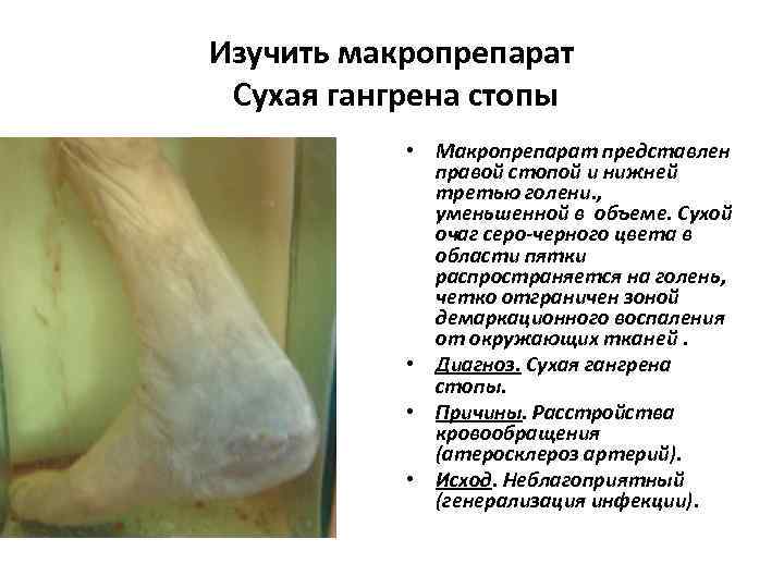 Изучить макропрепарат Сухая гангрена стопы • Макропрепарат представлен правой стопой и нижней третью голени.