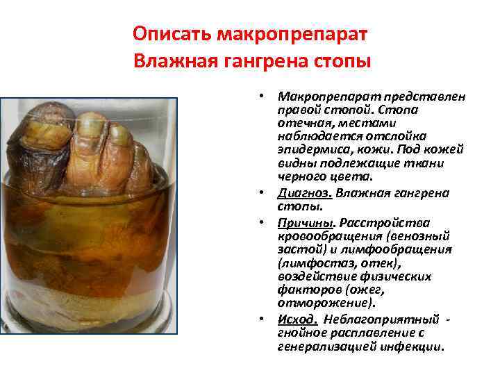 Описать макропрепарат Влажная гангрена стопы • Макропрепарат представлен правой стопой. Стопа отечная, местами наблюдается
