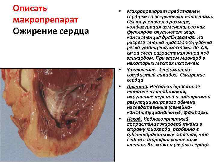 Описать макропрепарат Ожирение сердца • • Макропрепарат представлен сердцем со вскрытыми полостями. Орган увеличен