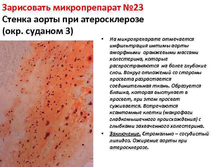 Зарисовать микропрепарат № 23 Стенка аорты при атеросклерозе (окр. суданом 3) • • На