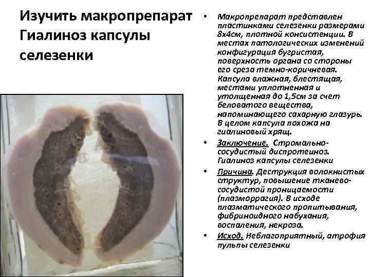 Изучить макропрепарат Гиалиноз капсулы селезенки • • Макропрепарат представлен пластинками селезенки размерами 8 х4