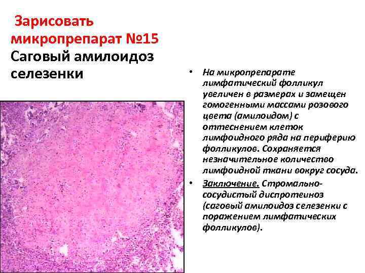  Зарисовать микропрепарат № 15 Саговый амилоидоз селезенки • На микропрепарате лимфатический фолликул увеличен