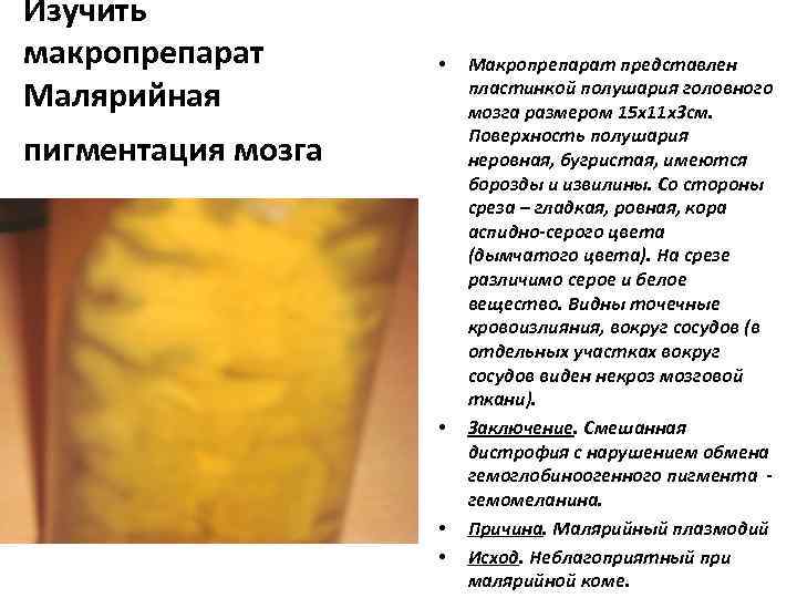 Изучить макропрепарат Малярийная • пигментация мозга • • • Макропрепарат представлен пластинкой полушария головного