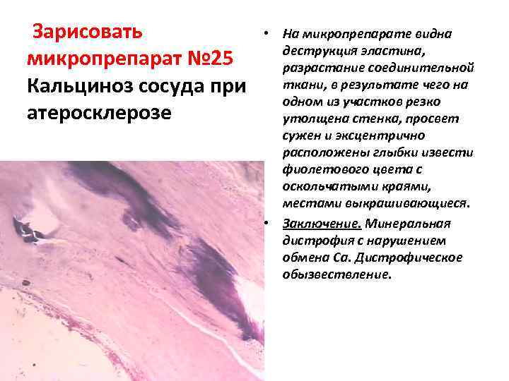  Зарисовать микропрепарат № 25 Кальциноз сосуда при атеросклерозе • На микропрепарате видна деструкция