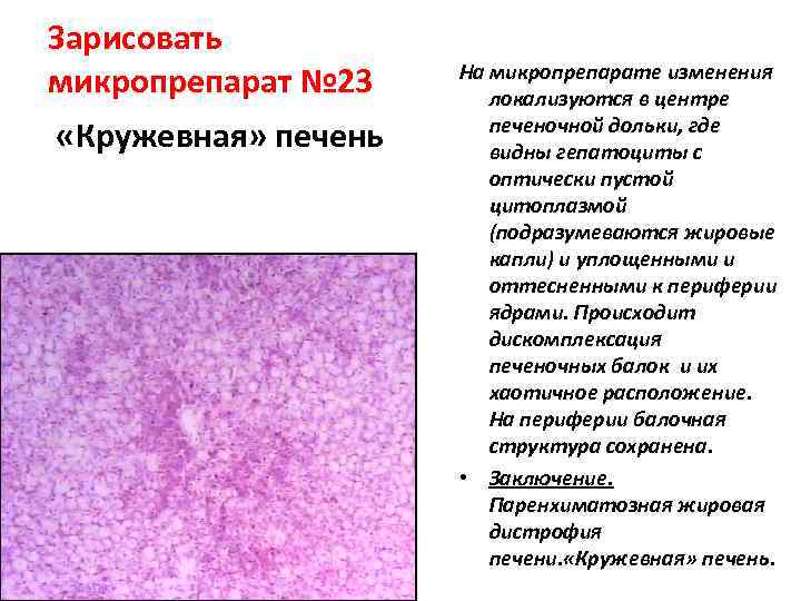 Зарисовать микропрепарат № 23 «Кружевная» печень На микропрепарате изменения локализуются в центре печеночной дольки,