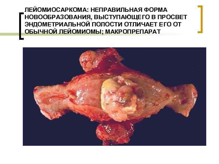 ЛЕЙОМИОСАРКОМА: НЕПРАВИЛЬНАЯ ФОРМА НОВООБРАЗОВАНИЯ, ВЫСТУПАЮЩЕГО В ПРОСВЕТ ЭНДОМЕТРИАЛЬНОЙ ПОЛОСТИ ОТЛИЧАЕТ ЕГО ОТ ОБЫЧНОЙ ЛЕЙОМИОМЫ;