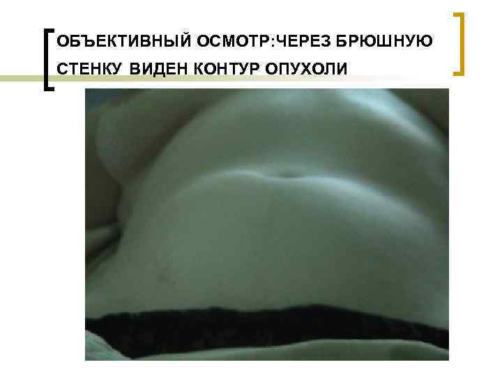 ОБЪЕКТИВНЫЙ ОСМОТР: ЧЕРЕЗ БРЮШНУЮ СТЕНКУ ВИДЕН КОНТУР ОПУХОЛИ 