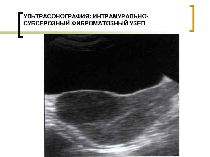 Фиброматозные узлы матки. Клиника рождающегося фиброматозного узла характеризуется. Двурогая матка и миома матки у подростков УЗИ картина.