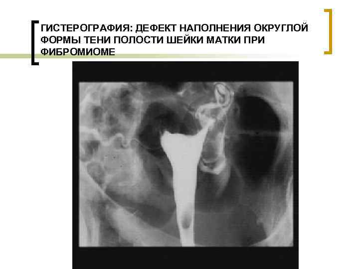 ГИСТЕРОГРАФИЯ: ДЕФЕКТ НАПОЛНЕНИЯ ОКРУГЛОЙ ФОРМЫ ТЕНИ ПОЛОСТИ ШЕЙКИ МАТКИ ПРИ ФИБРОМИОМЕ 