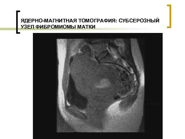 Субсерозная миома матки фото