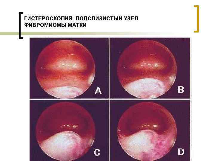 Фибромиома матки фото матки